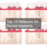 Top 10 Reasons for Dental Implants