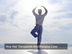 How Hair Transplants Are Changing Lives